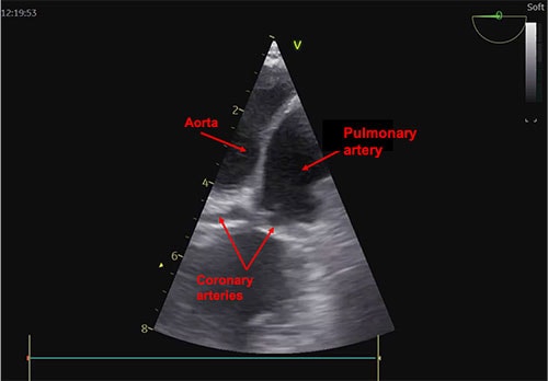 Transoesophageal echo and CT