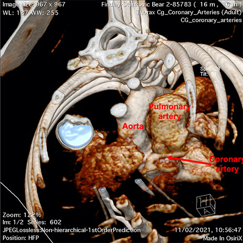 CT image showing normal coronary artery anatomy