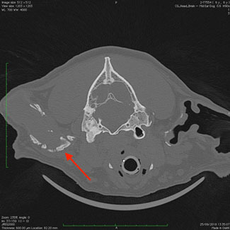 CT demonstrating severe calcification (red arrow) of external ear canal