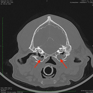 CT demonstrating both bulla filled with a soft tissue density (normal bulla should be air filled and therefore black). CT consistent with bilateral otitis media