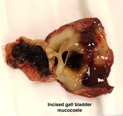 Gall bladder mucocoele